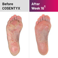 Plaque psoriasis treatment on bottom of feet before and after COSENTYX