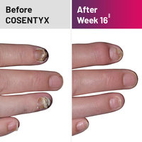 Plaque psoriasis treatment on nails before and after COSENTYX