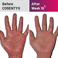 Plaque psoriasis treatment on palms before and after COSENTYX
