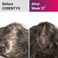 Plaque psoriasis treatment on scalp before and after COSENTYX
