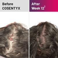 Plaque psoriasis treatment on scalp before and after COSENTYX