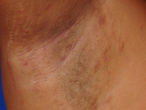 Image showing Hidradenitis Suppurativa (HS) severe symptoms in Hurley stage I