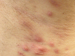 Image showing Hidradenitis Suppurativa (HS) severe symptoms in Hurley stage II