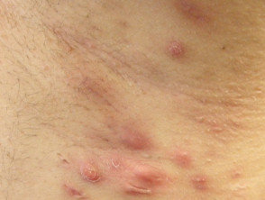 Image showing Hidradenitis Suppurativa (HS) moderate symptoms in Hurley stage 2