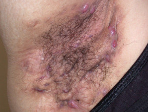 Image showing Hidradenitis Suppurativa (HS) severe symptoms in Hurley stage III